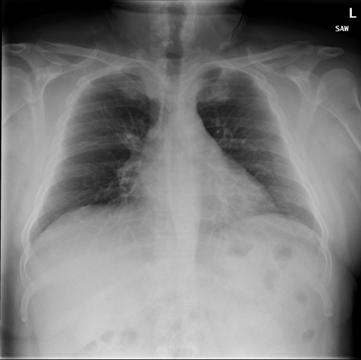 CXR192_IM-0598-1001.png