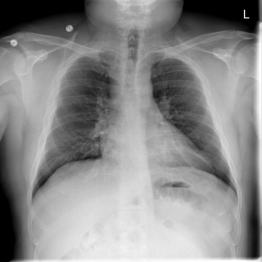 CXR193_IM-0601-1001.png