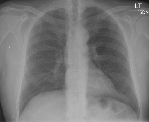 CXR191_IM-0591-1001.png